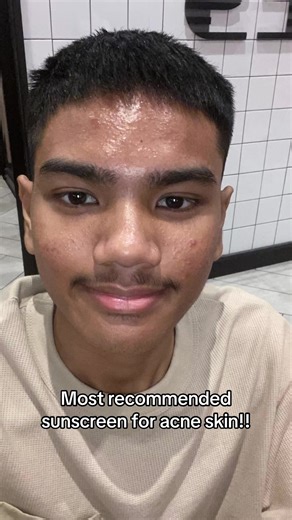 Best Sunscreen for Acne-Prone Skin | Y.O.U. Sunbrella