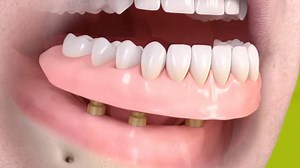 Are you tired of struggling with loose dentures? At Cloverdale...