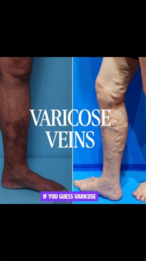 Deekshita on Instagram: "(8/30) LETS REVISE ONCE AGAIN Chronic complication of venous insufficiency • Due to venous hypertension • Capillary leak → fibrin cuff formation • Tissue hypoxia • RBC extravasation → haemosiderin pigmentation • Chronic inflammation (panniculitis) • Fat necrosis → fibrosis • Skin becomes hard, tight, pigmented • Lower leg narrowing → inverted champagne bottle 🍾 • Precedes venous ulceration #consistencyiskey🗝️ #journaling #medschool #mbbs #motivation"