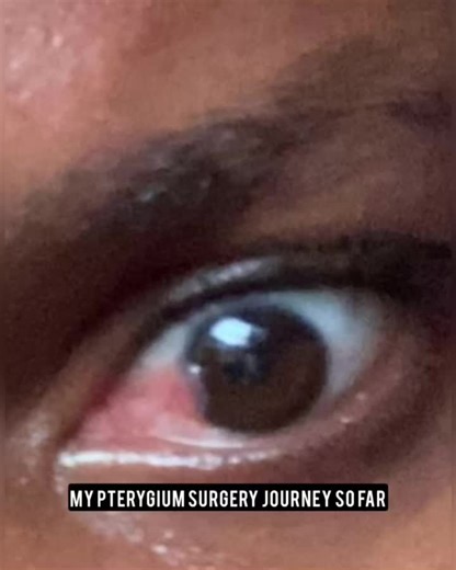Successful Eye Surgery for Pterygium Recovery