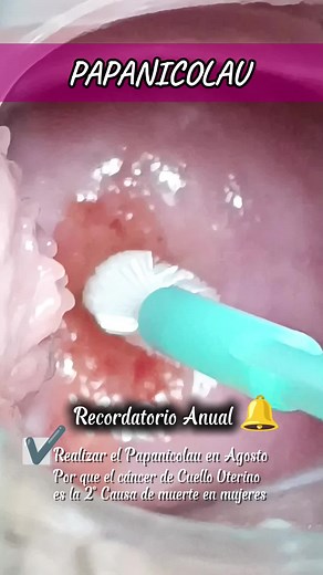 Recordatorio 🔔 ✨El Papanicolaou se realiza cada año para detectar cambio celular, lesiones o cáncer en el cuello uterino. ✨Recordar que el cáncer de cuello uterino es la 2 causa de muerte en las mujeres. #fyp #viral #parati #lesiondealtogrado #lesiondealtogrado #virusdepapiloma #vph #obstetraitala #obstetra_itala #consultorio #villamariadeltriunfo #pap #cancer #papanicolau