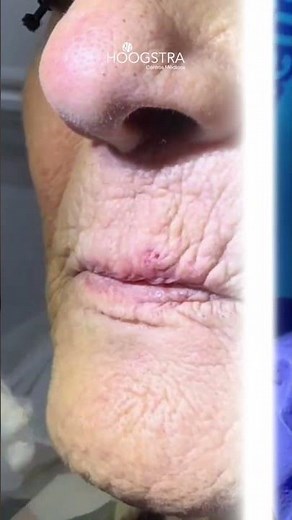 Eliminación de quiste facial