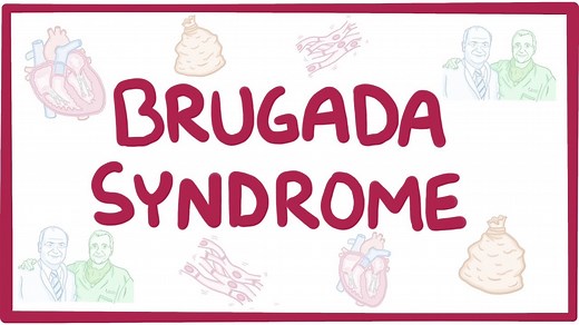 Brugada syndrome: Video, Causes, & Meaning | Osmosis