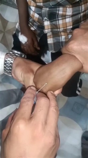 Cannulation.. videos.. part 1048 #shorts #viral #trending