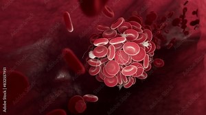 3D animation of a blood clot moving through a blood vessel.