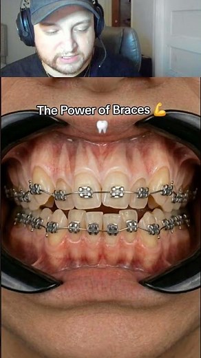 HOW BRACES WORK 🤔