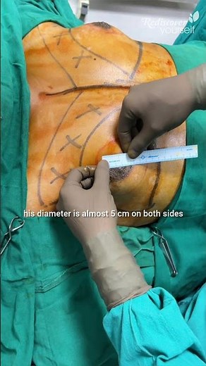 Does Areola Size Decrease After Gynecomastia Surgery? | 5 cm Areola Case Revealed