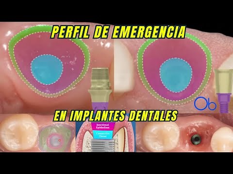 Emergency Profile in Dental Implantology