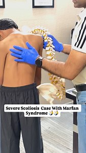 Scoliosis With Marfan syndrome is a genetic disorder affecting connective tissue, leading to often tall, thin builds with long limbs, flexible joints, and potential issues in the heart (especially the aorta), eyes (dislocated lens), skeleton (curved spine, flat feet), lungs, and skin, caused by a mutation in the FBN1 gene. #scoliosis #spine #marfan #india #shorts | DrRavi Yadav