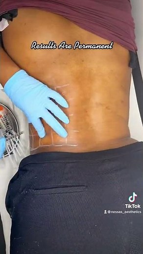 Fat Dissolving Injections | Melt Stubborn Fat