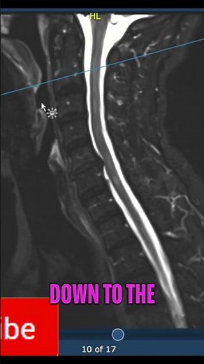 Spotting MS Spinal Lesions MRI Scan Analysis