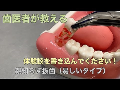 易しいタイプの親知らず抜歯 2021年製作