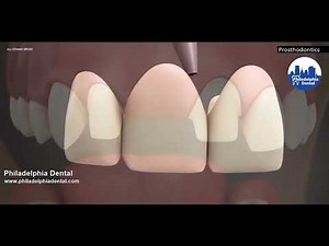Ceramic (porcelain) Dental Bridge - by Philadelphia Dental