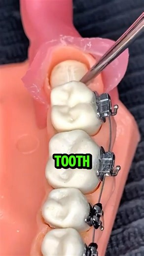 Tooth Growing Inside The Gums!? 😬