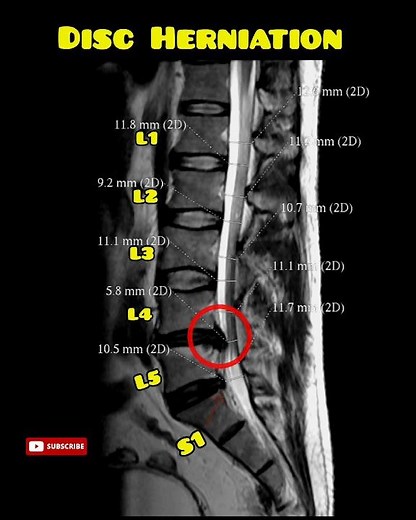 Lumbar spine disc bulge | disc Herniation MRI spine #mrispine #discbulge #backache