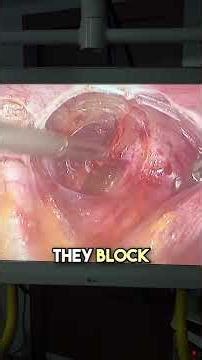 Bloodless Fibroid Removal Technique!