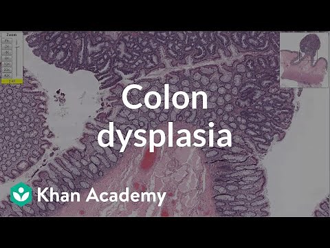 Colon dysplasia | Gastrointestinal system diseases | Health & Medicine | Khan Academy