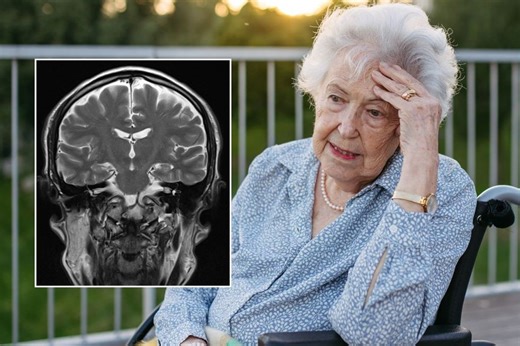 Alzheimer's breakthrough as 'game-changing' drug shown to 'suck plaque out of the brain' within weeks
