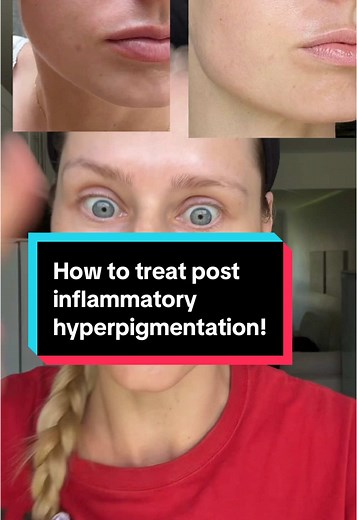 How to Treat Post Inflammatory Hyperpigmentation
