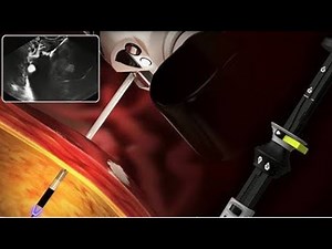 HOW TO DEPLOY HOT AXIOS STENT EUS-guided drainage pseudocyst Hot AXIOS stent Step by Step