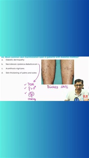 Diabetic Dermopathy
