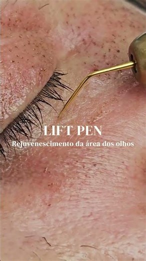 Lift Pen: rejuvenescimento dos olhos sem cirurgia
