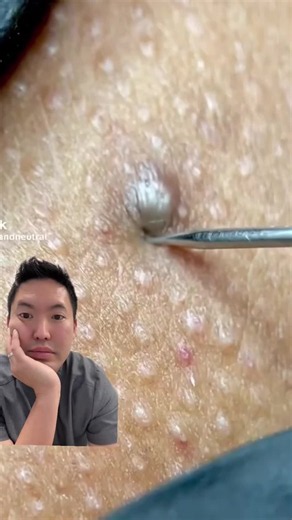 Who would have been upset if I didn’t move my head out of the way? 😮 These “dilated pores” or cyst-like bumps often refill because the sac/cyst wall is still underneath the skin. Extracting the keratin and oil gives temporary relief, but definitive treatment usually means removing the entire cyst wall and pore lining with a punch excision or small surgical procedure to reduce recurrence. 💉🩹 And no — please don’t go digging at these aggressively at home unless you want inflammation, infection,