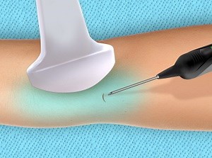 Ultrasonic Tendon Scar Tissue Removal (Percutaneous Method)