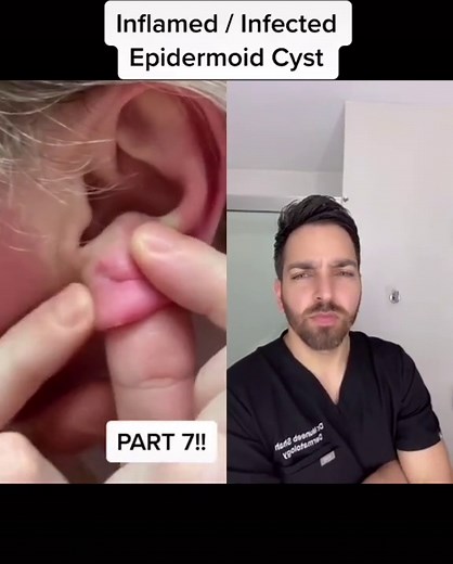 Expert Pimple-Popping Techniques by a Dermatologist