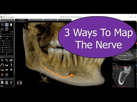 CS 3D Imaging - 3 Ways To Map The Nerve