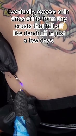 💥Skin tags are small, harmless growths that can appear anywhere the neck, underarms, face, or body.