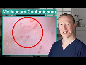 Molluscum Contagiosum: causes, diagnosis and treatments