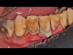Tartar Removal Before and After - Satisfying video #013