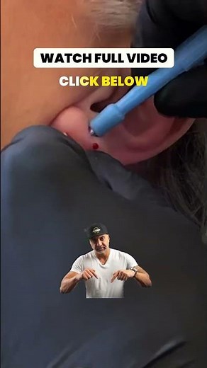 EARLOBE REPAIR