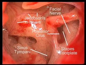 Middle Ear Endoscopy • Video • MEDtube.net