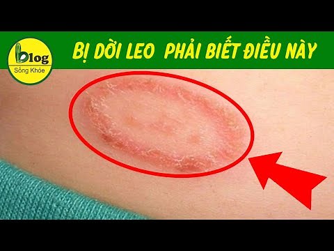 5 phút tìm hiểu về bệnh dời leo và cách điều trị