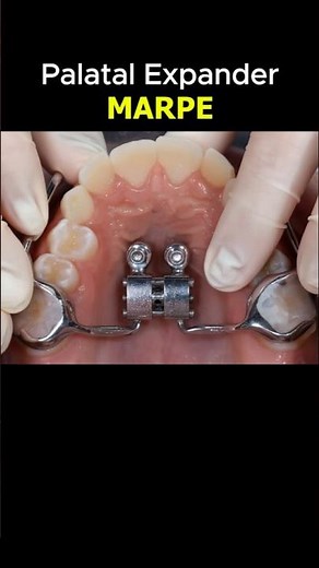 Palatal expander MARPE. Then braces are used to achieve best results #braces #orthodontist #dentist