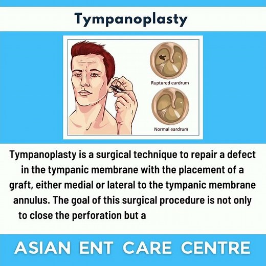 Tympanoplasty | Repairing the Ear Drum| Eardrum Hole Surgery| Dr. Chava Anjaneyulu Chief ENT Surgeon