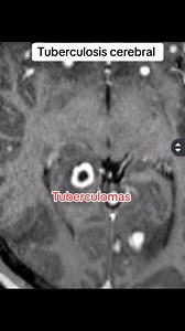 Así se ve la tuberculosis cerebral. Comparte si te gusta mi contenido radiológico ☢️ #medicina #radiología #tuberculosis #estudiante #hospital #resonancia | LaRadiologamargada