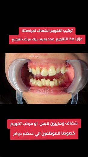 تركيب التقويم الشفاف: جمال وراحة