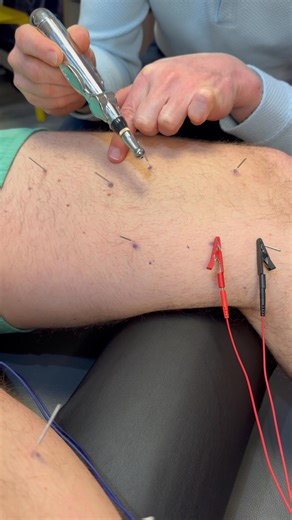 452K views · 68 reactions |  Dry Needling for Muscle Relief...