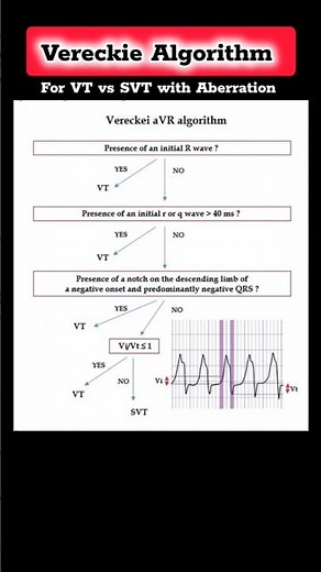 Vereckie Algorithm for VT vs SVT on ECG #vt #svt #ecg #heart