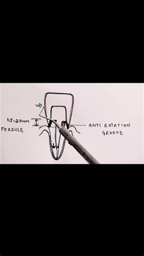 Ferrule Effect and its Clinical Significance #dental #dentalcare #study #clinic