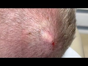 Pillar cyst Removal from the scalp