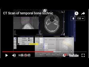 CT Scan of temporal bone technic