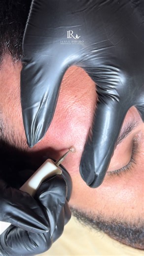 Remoción de arrugas: Jato de plasma y acrocordones