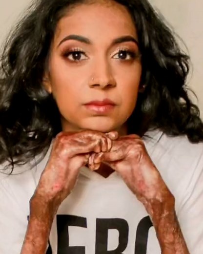 1.4K views | She can’t be touched without blistering  | Real Fix | Facebook