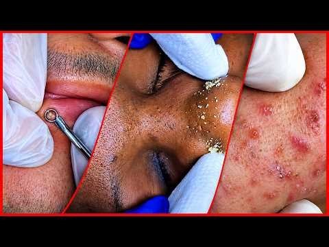 3.6.9. 56 Minutes Blackheads Removal | How to get Rid of Blackheads on the fac | ACNE Treatment #59