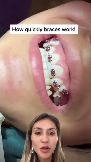 Watch How Fast Braces Work