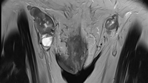 Vulval cancer survivor shared what every women should know about it